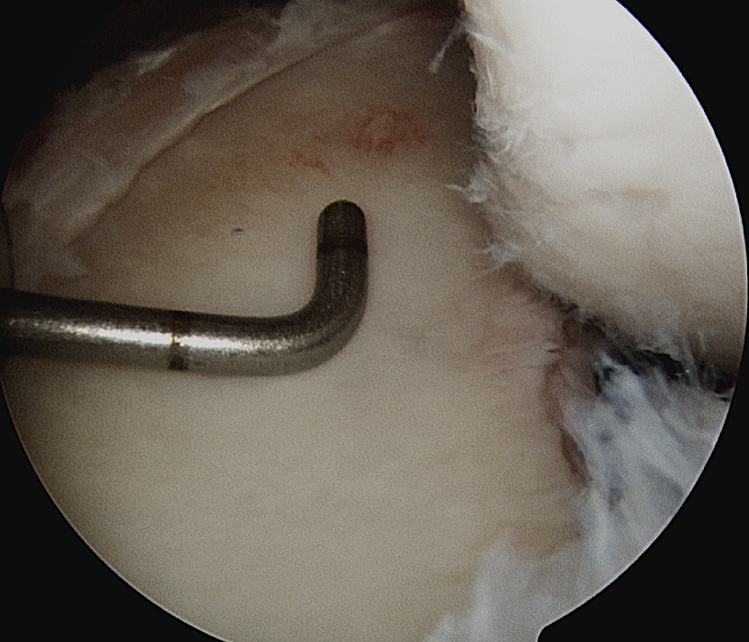 Glenoid Bone Loss Measurement 1